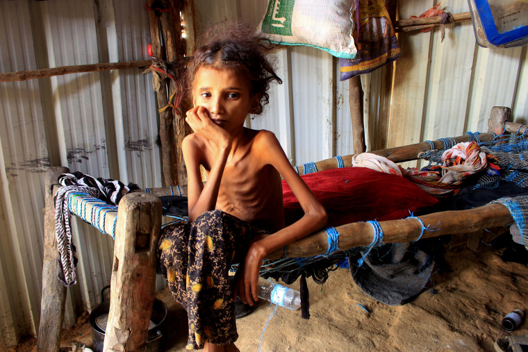 Ahmadia Abdo, 10, who suffers from acute malnutrition, at a camp for the internally displaced in Yemen's Hajjah Governorate in January 2021.